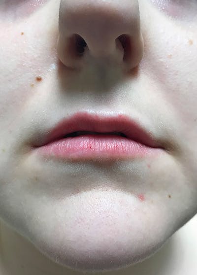 Lip Enhancement Before & After Gallery - Patient 5883915 - Image 2