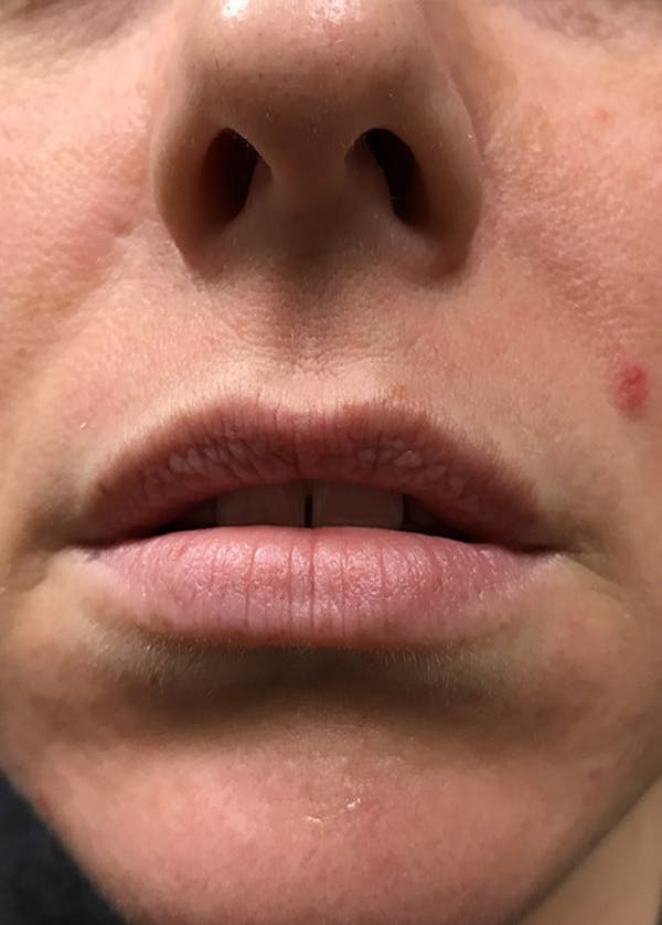 Lip Enhancement Before & After Gallery - Patient 5883919 - Image 1