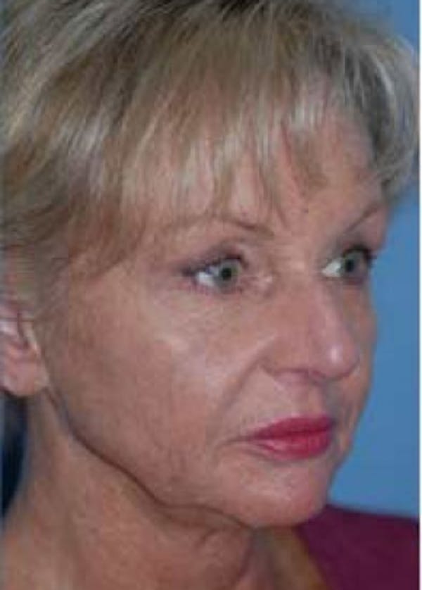Facelift and Mini Facelift Gallery - Patient 5883918 - Image 1