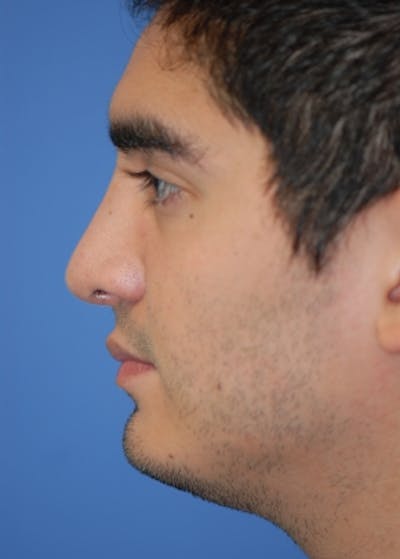 Rhinoplasty Before & After Gallery - Patient 5883920 - Image 2