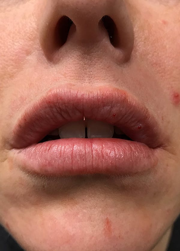 Lip Enhancement Before & After Gallery - Patient 5883919 - Image 2
