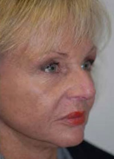 Facelift and Mini Facelift Before & After Gallery - Patient 5883918 - Image 2
