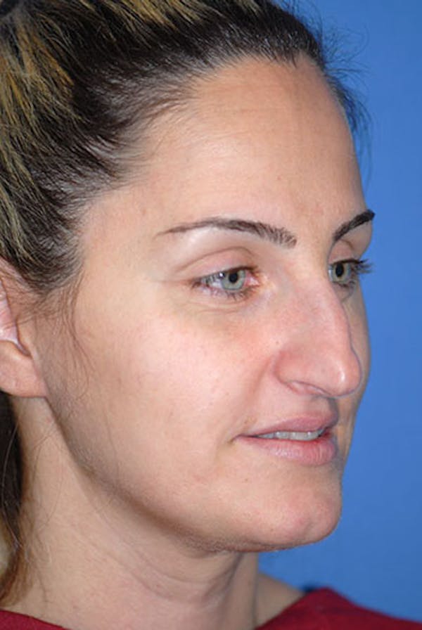 Rhinoplasty Before & After Gallery - Patient 5883921 - Image 1