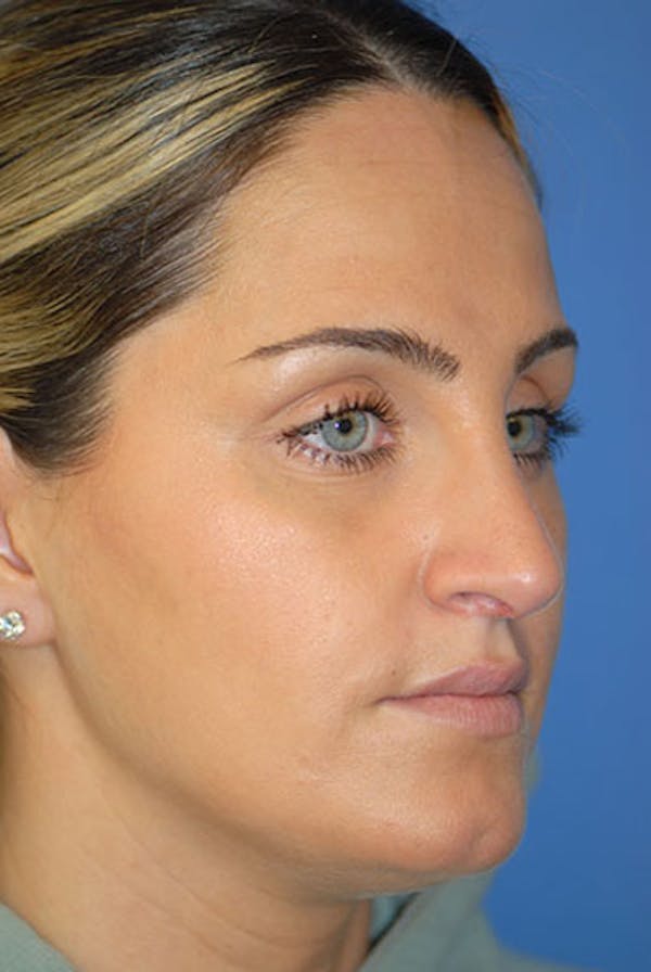 Rhinoplasty Before & After Gallery - Patient 5883921 - Image 2