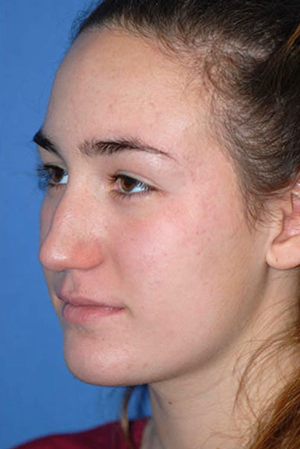 Rhinoplasty Before & After Gallery - Patient 5883922 - Image 1
