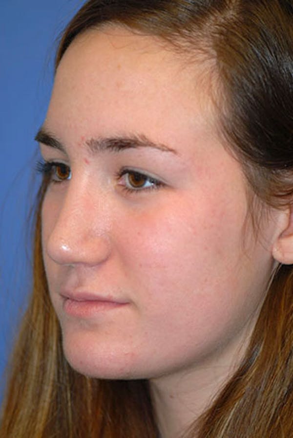 Rhinoplasty Before & After Gallery - Patient 5883922 - Image 2