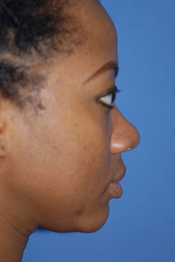 Rhinoplasty Before & After Gallery - Patient 5883923 - Image 1
