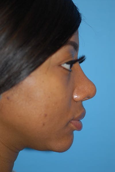 Rhinoplasty Before & After Gallery - Patient 5883923 - Image 2