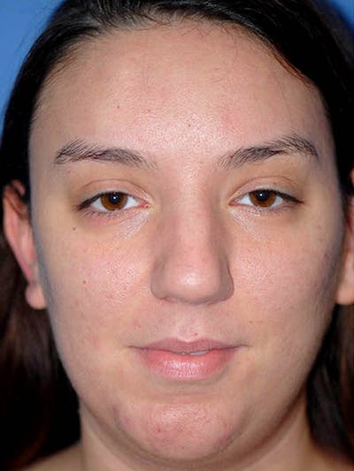 Rhinoplasty Before & After Gallery - Patient 5883927 - Image 1