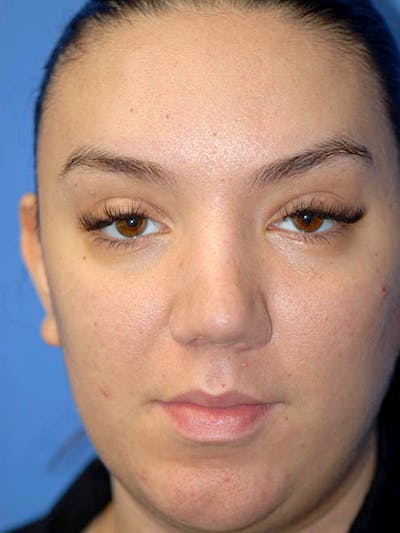 Rhinoplasty Before & After Gallery - Patient 5883927 - Image 2