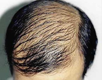 Hair Transplant Before & After Gallery - Patient 5883924 - Image 1
