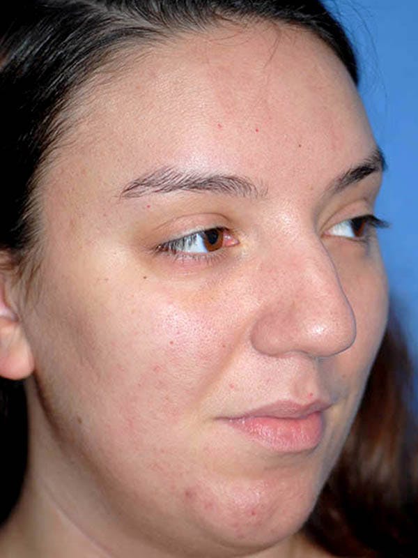 Rhinoplasty Before & After Gallery - Patient 5883927 - Image 3