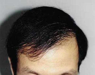 Hair Transplant Gallery - Patient 5883924 - Image 2