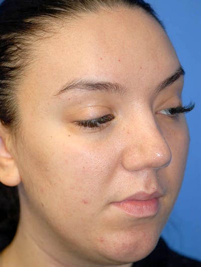 Rhinoplasty Before & After Gallery - Patient 5883927 - Image 4