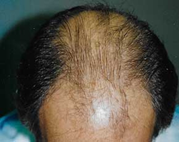 Hair Transplant