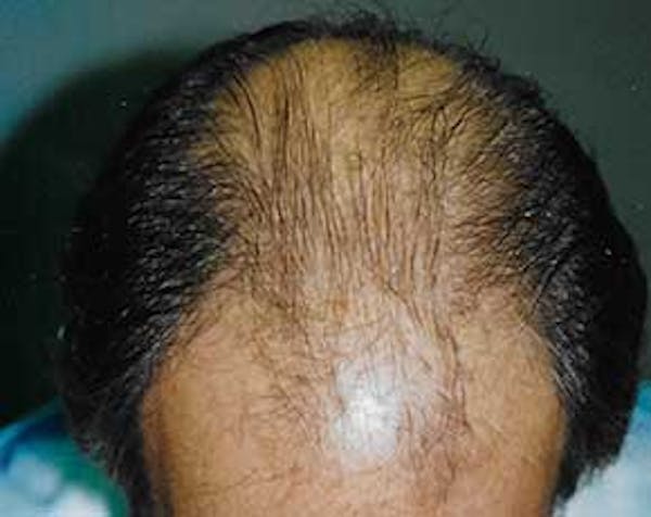 Hair Transplant Gallery - Patient 5883926 - Image 1