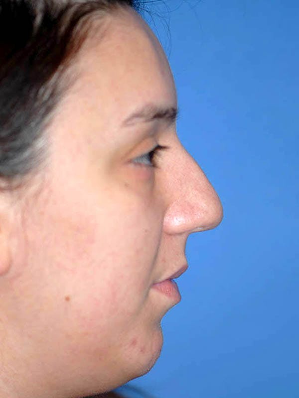Rhinoplasty Before & After Gallery - Patient 5883927 - Image 5