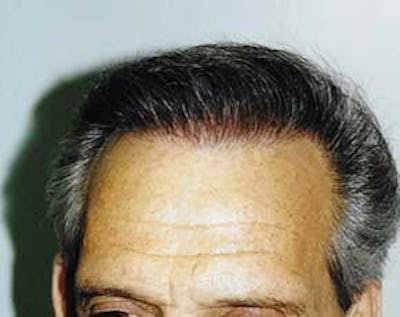 Hair Transplant Before & After Gallery - Patient 5883926 - Image 2