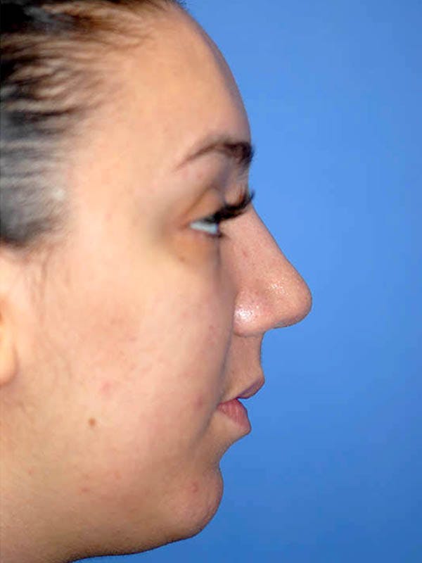 Rhinoplasty Before & After Gallery - Patient 5883927 - Image 6