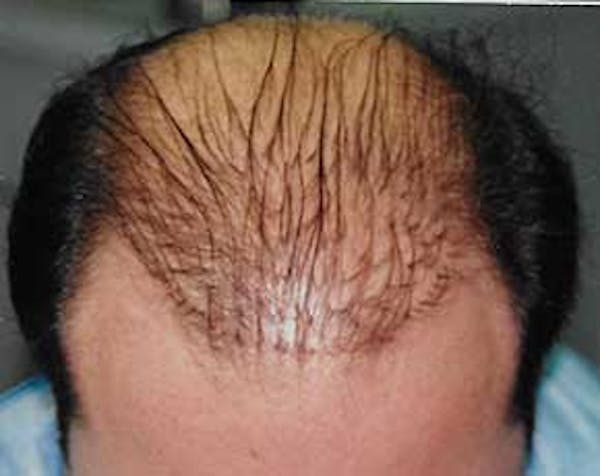 Hair Transplant Before & After Gallery - Patient 5883929 - Image 1