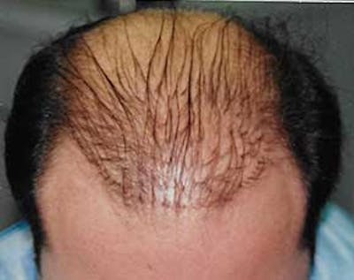Hair Transplant Before & After Gallery - Patient 5883929 - Image 1