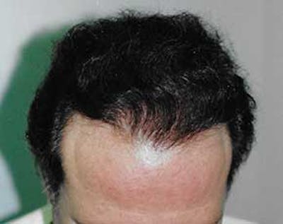 Hair Transplant Before & After Gallery - Patient 5883929 - Image 2
