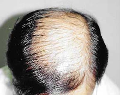 Hair Transplant Gallery - Patient 5883932 - Image 1