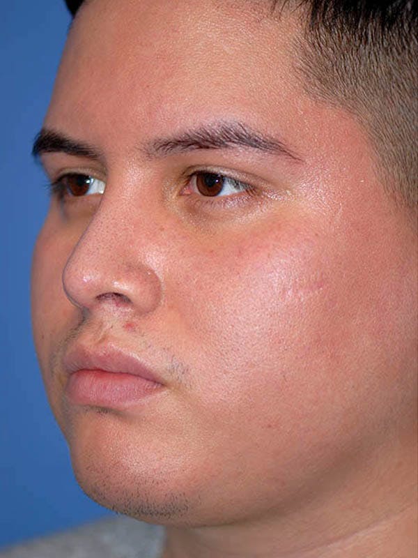 Rhinoplasty Before & After Gallery - Patient 5883933 - Image 2