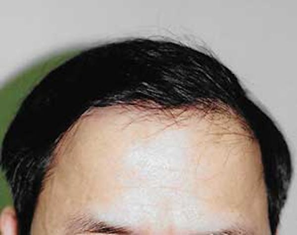 Hair Transplant Before & After Gallery - Patient 5883932 - Image 2