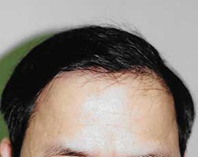 Hair Transplant Gallery - Patient 5883932 - Image 2