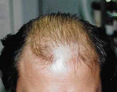 Hair Transplant Before & After Gallery - Patient 5883934 - Image 1