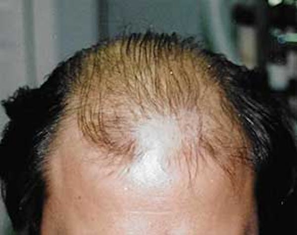 Hair Transplant Before & After Gallery - Patient 5883934 - Image 1