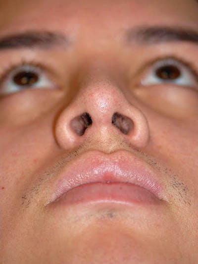 Rhinoplasty Before & After Gallery - Patient 5883933 - Image 4