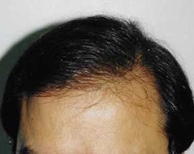 Hair Transplant Before & After Gallery - Patient 5883934 - Image 2