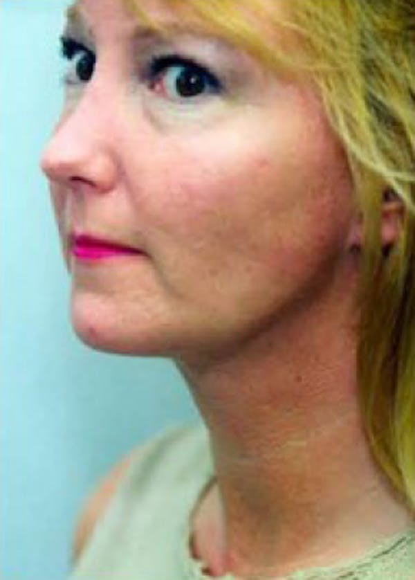 Necklift & Necklipo Before & After Gallery - Patient 5883935 - Image 2