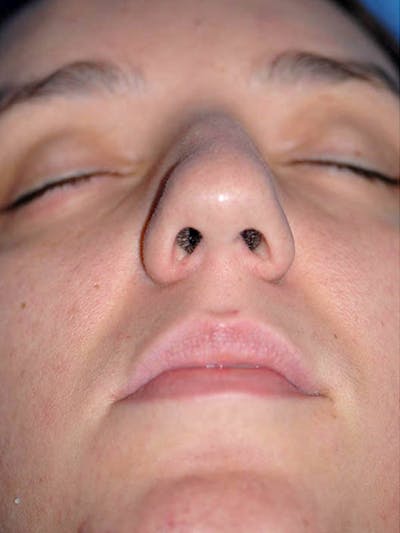 Rhinoplasty Before & After Gallery - Patient 5883937 - Image 1