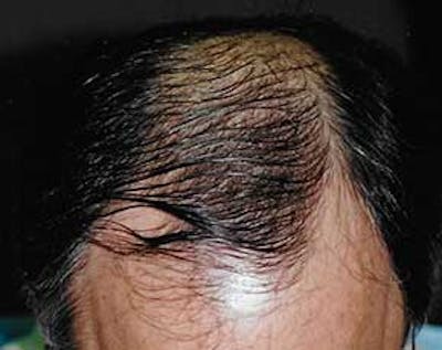 Hair Transplant Before & After Gallery - Patient 5883936 - Image 1