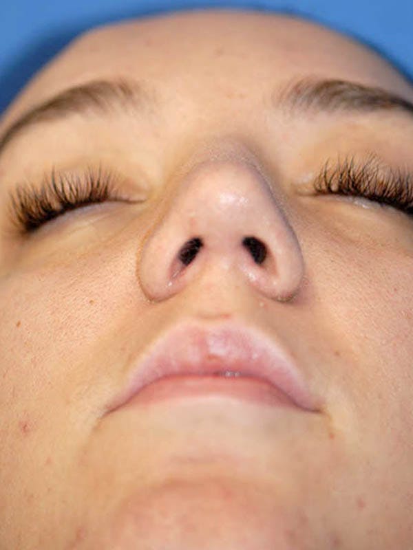 Rhinoplasty Before & After Gallery - Patient 5883937 - Image 2