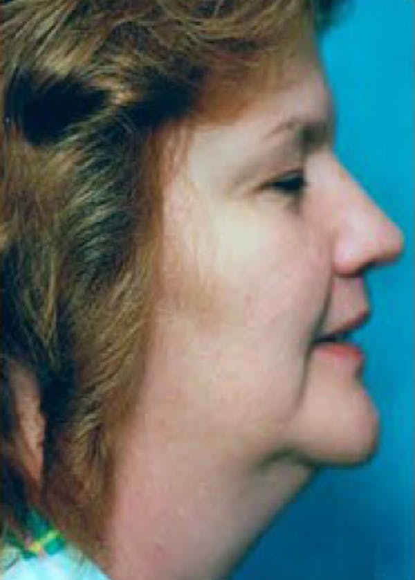 Necklift & Necklipo Before & After Gallery - Patient 5883938 - Image 1