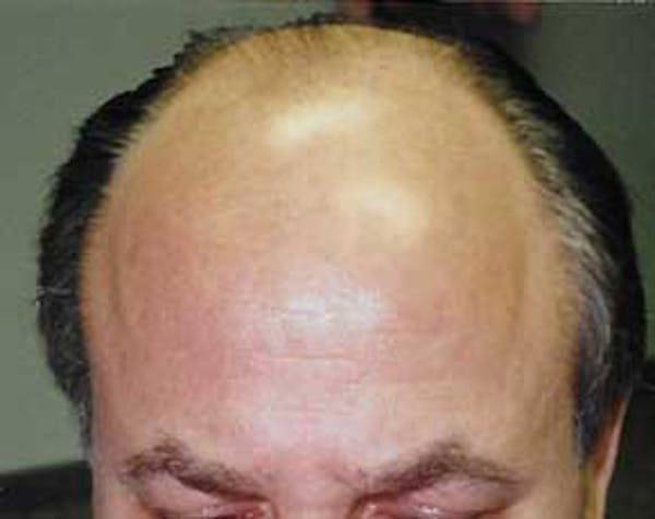 Hair Transplant Before & After Gallery - Patient 5883939 - Image 1