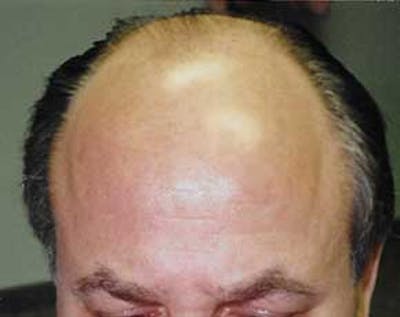 Hair Transplant Before & After Gallery - Patient 5883939 - Image 1