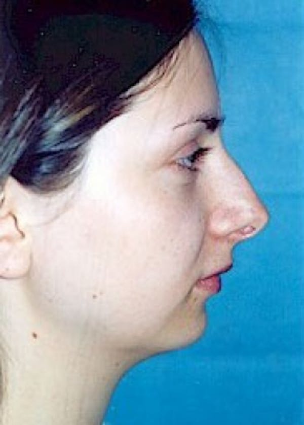 Rhinoplasty Before & After Gallery - Patient 5883940 - Image 1