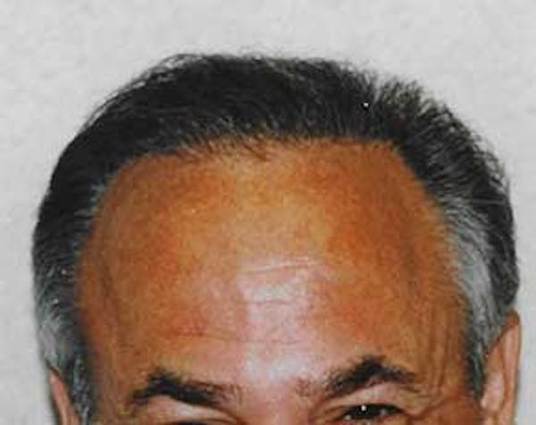 Hair Transplant Before & After Gallery - Patient 5883939 - Image 2