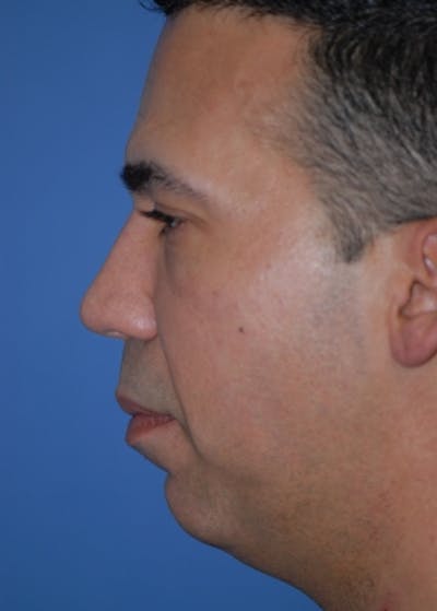 Necklift & Necklipo Before & After Gallery - Patient 5883941 - Image 1