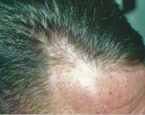 Hair Transplant Before & After Gallery - Patient 5883942 - Image 1