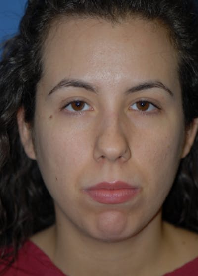 Rhinoplasty Before & After Gallery - Patient 5883944 - Image 1