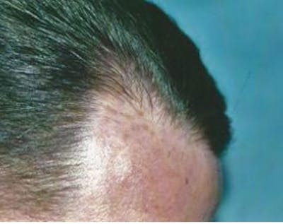 Hair Transplant Before & After Gallery - Patient 5883942 - Image 2
