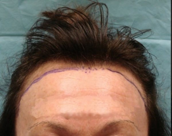 Hair Transplant Before & After Gallery - Patient 5883943 - Image 1