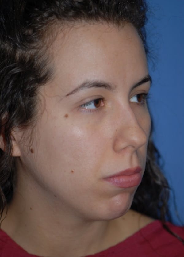 Rhinoplasty Before & After Gallery - Patient 5883944 - Image 3