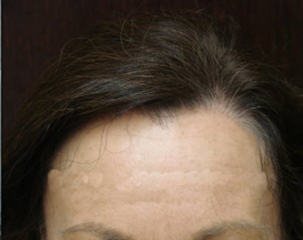Hair Transplant Before & After Gallery - Patient 5883943 - Image 2